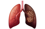 Lung cancer