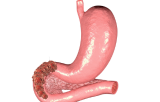 Duodenal cancers