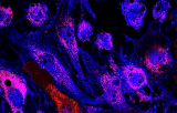 CSF1R probe for FISH CE/IVD - Acute lymphoblastic leukemia (ALL)