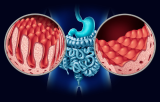 Gastrointestinal diseases