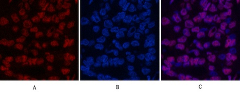 Fig.5. Immunofluorescence analysis of human liver cancer tissue. 1, Histone H3 Monoclonal Antibody (2D10) (red) was diluted at 1:200 (4°C, overnight). 2, Cy3 Labeled secondary antibody was diluted at 1:300 (room temperature, 50min). 3, Picture B: DAPI (blue) 10min. Picture A: Target. Picture B: DAPI. Picture C: merge of A+B.