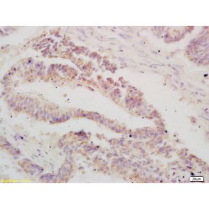 Human colon carcinoma