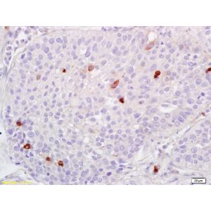 Human lung carcinoma