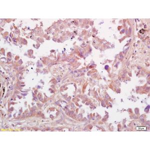 Human lung carcinoma
