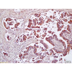 Human lung carcinoma