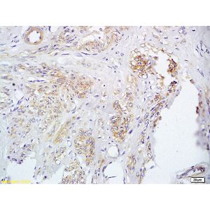 Human cervical carcinoma