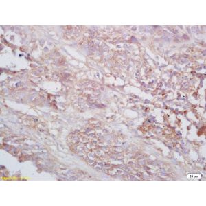 Human lung carcinoma