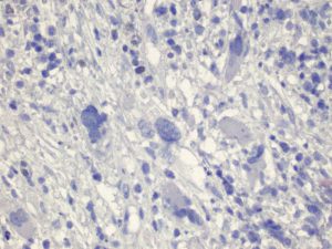 Immunohistochemical staining (IHC) with anti-mutated CALR Antibody (clone CAL2) - dianova