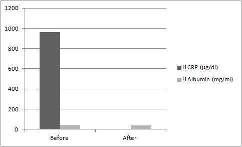 Human C-Reactive Protein (CRP) Deficient Plasma (EDTA)