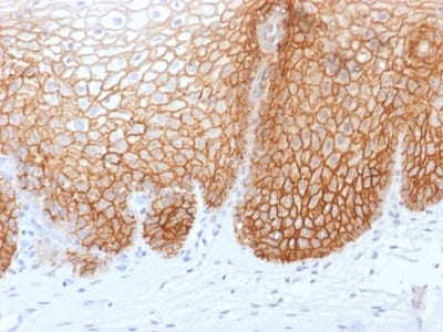 Formalin-fixed paraffin-embedded human Cervical Carcinoma stained with CD44v9 Mouse Recombinant Monoclonal Antibody (rCD44v9/1459).