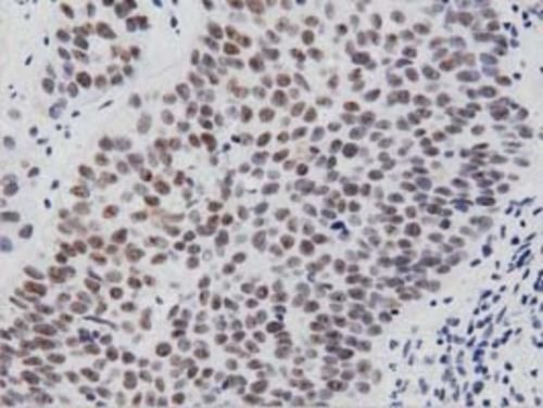 Immunohistochemical staining of paraffin-embedded Carcinoma of Human bladder tissue using anti-PTPRE mouse monoclonal antibody. (TA501234; heat-induced epitope retrieval by 1mM EDTA in 10mM Tris, pH8.5, 120°C for 3min). Heat-induced epitope retrieval by EDTA solution buffer pH 8.0 at 120°C for 3 min.