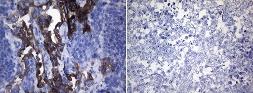 Immunohistochemical staining of paraffin-embedded HCC78 (left) and HeLa (right) xenograft using TA805804 (0.2ug/ml). Heat-induced epitope retrieval by EDTA solution buffer pH 8.0 at 120°C for 3 min.