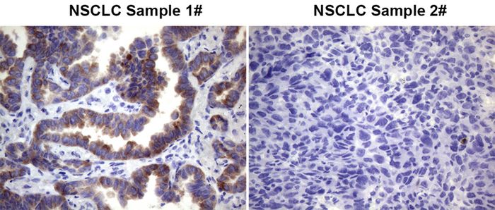 Immunohistochemical staining of paraffin-embedded non-small cell lung cancer tissues (case1 was ROS1-positive, Case2 was ROS1-negative) using TA805804 (0.2ug/ml). Heat-induced epitope retrieval by EDTA solution buffer pH 8.0 at 120°C for 3 min.
