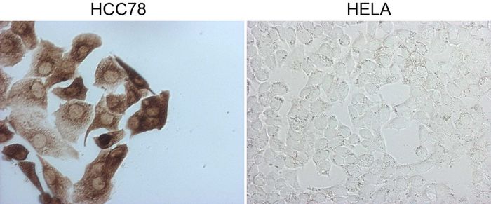 Immunocytochemistry staining of HCC78 cells using anti-ROS1 mouse monoclonal antibody (TA805804) (Left). The right is HELA cells as negative control.