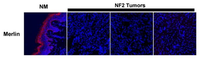 Figure from citation: Immunofluorescence of DDK (FLAG) protein level by using anti-DDK antibody in tumor specimens and normal tissue derived from patients with NF2. Dilution: 1:200 <a href="http://www.ncbi.nlm.nih.gov/pubmed/21383154" target="_blank">View Citation</a>