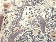 Immunohistochemistry staining with anti-human HLA-G (MEM-G/1) - pulmonary disseases (paraffin-embedded sections). The antibody MEM-G/1 stains infiltrating macrophages in pulmonary diseases. In the top left corner see the detail of macrophage.