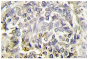Immunohistochemistry analysis of ASC Antibody in paraffin-embedded human lung carcinoma tissue.