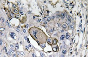 Immunohistochemistry analysis of AQP5 Antibody in paraffin-embedded human lung carcinoma tissue.