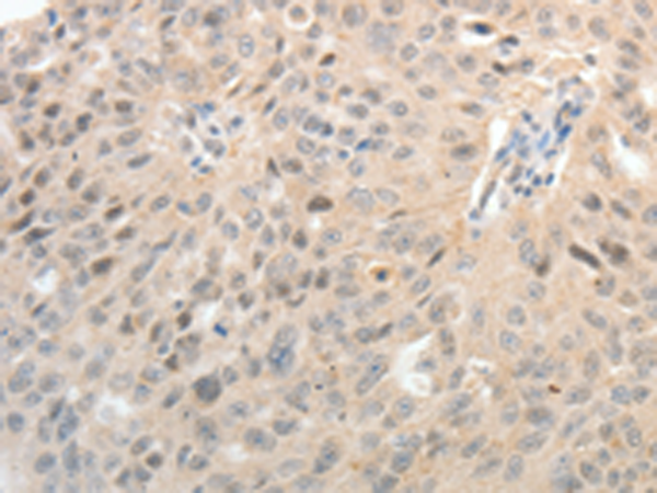Immunohistochemistry of paraffin-embedded Human ovarian cancer tissue using TA321640 (ASCL1 Antibody) at dilution 1/30 (Original magnification: ×200)