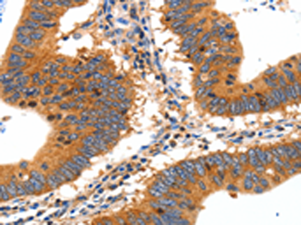 Immunohistochemistry of paraffin-embedded Human colon cancer tissue using TA321791 (SLC2A2 Antibody) at dilution 1/30 (Original magnification: ×200)