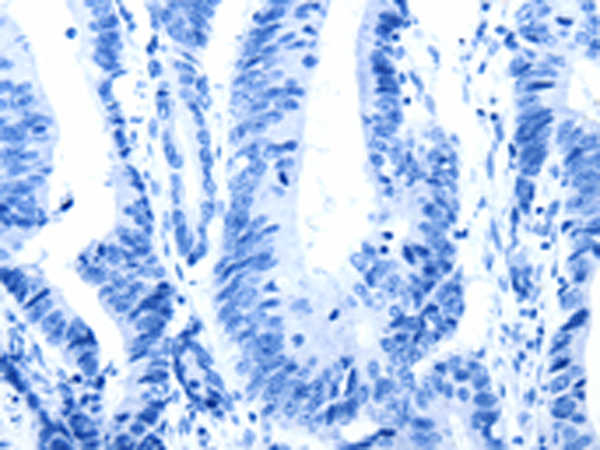 Immunohistochemistry of paraffin-embedded Human colon cancer tissue using TA321791 (SLC2A2 Antibody) at dilution 1/30, treated with synthetic peptide. (Original magnification: ×200)