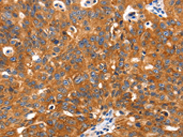 Immunohistochemistry of paraffin-embedded Human ovarian cancer tissue using TA321791 (SLC2A2 Antibody) at dilution 1/30 (Original magnification: ×200)
