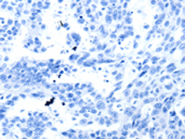 Immunohistochemistry of paraffin-embedded Human ovarian cancer tissue using TA321791 (SLC2A2 Antibody) at dilution 1/30, treated with synthetic peptide. (Original magnification: ×200)