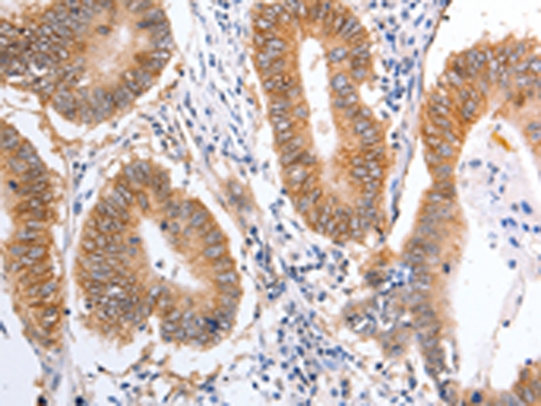 Immunohistochemistry of paraffin-embedded Human colon cancer tissue using TA324094 (PIWIL1 Antibody) at dilution 1/25 (Original magnification: ×200)