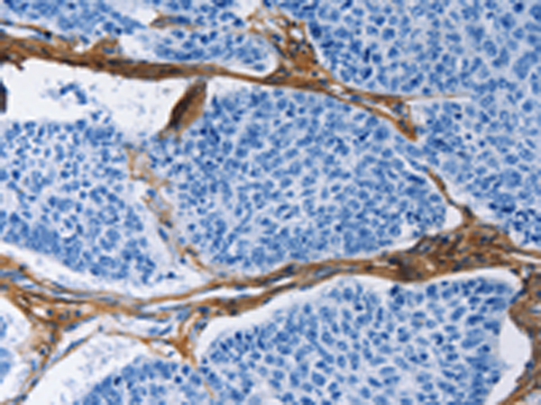 Immunohistochemistry of paraffin-embedded Human lung cancer tissue using TA364441 (COL3A1 Antibody) at dilution 1/60 (Original magnification: ×200)