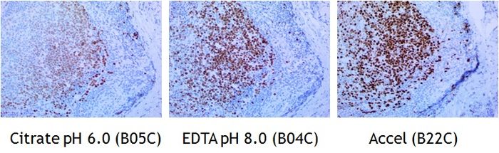 IHC staining of FFPE human tonsil tissue within normal limits using mouse anti-human Ki67 monoclonal antibody and Polink-1 HRP Broad for DAB D11-18. Heat-induced epitope retrieval by Citrate Buffer pH 6.0 (Cat. No.: B05C-100), EDTA Solution pH 8.0 (Cat. No.: <a href = "https://www.origene.com/catalog/assay-kits/ihc-kits-and-reagents/b04c-100-edta-buffer-solution-20x" title="B04C-100" class="">B04C-100</a>), and Accel Retrieval Solution (<a href = "https://www.origene.com/catalog/assay-kits/ihc-kits-and-reagents/b22c-125-accel-retrieval-solution-20x" title="B22C-125" class="">B22C-125</a>) (15-20 minutes at 95 C-100 C). The brown stain indicates positive stain and blue is the counter stain. It is mounted using a permanent Organic mounting medium E37-100.