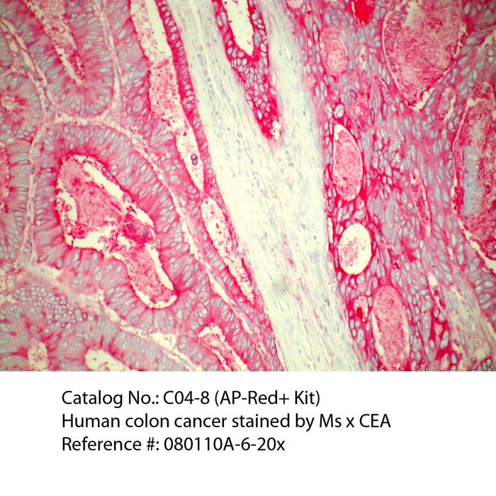 IHC staining of FFPE human colon cancer tissue using mouse anti-CEA polyclonal antibody, Polink-1 AP Mouse detection kit D18-18, and AP-Red+ Kit (Cat. No.: C04-8). The red stain indicates positive stain and blue is the counter stain. It is mounted using a permanent aqueous mounting medium <a href = "https://www.origene.com/catalog/assay-kits/ihc-kits-and-reagents/e03-18-simpo-mount-aqueous" title="E03-18" class="">E03-18</a>.