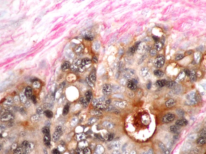 Human colon cancer  screened with Ms anti-PCNA  requiered HIER buffer Citrate pH6 (B21C-100) and visualized with DAB Ni (C10-12) resulting in a  black nuclear stain.   This image  is part of a triple stain showing MsxSMActin staining in red using GBI permanent Red (<a href = "https://www.origene.com/catalog/assay-kits/ihc-kits-and-reagents/c13-18-alkaline-phosphatase-red-chromogen-kit" title="C13-18" class="">C13-18</a>) and RbxCEA staining in brown using DAB (<a href = "https://www.origene.com/catalog/assay-kits/ihc-kits-and-reagents/c09-12-dab-chromogen-kit" title="C09-12" class="">C09-12</a>). Secondary and chromogens were supplied in TS301B