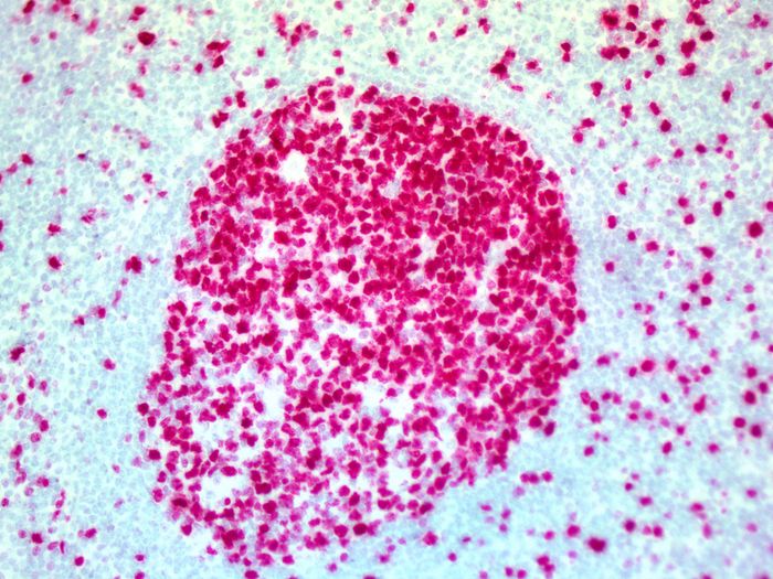 IHC staining of FFPE human tonsil tissue within normal limits using mouse anti-Ki67 monoclonal antibody, Polink-1 AP Mouse detection kit D18-18, and GBI-Permanent red Kit (Cat. No.: C13). The red stain indicates positive stain and blue is the counter stain. It is mounted using a permanent aqueous mounting medium <a href = "https://www.origene.com/catalog/assay-kits/ihc-kits-and-reagents/e03-18-simpo-mount-aqueous" title="E03-18" class="">E03-18</a>.