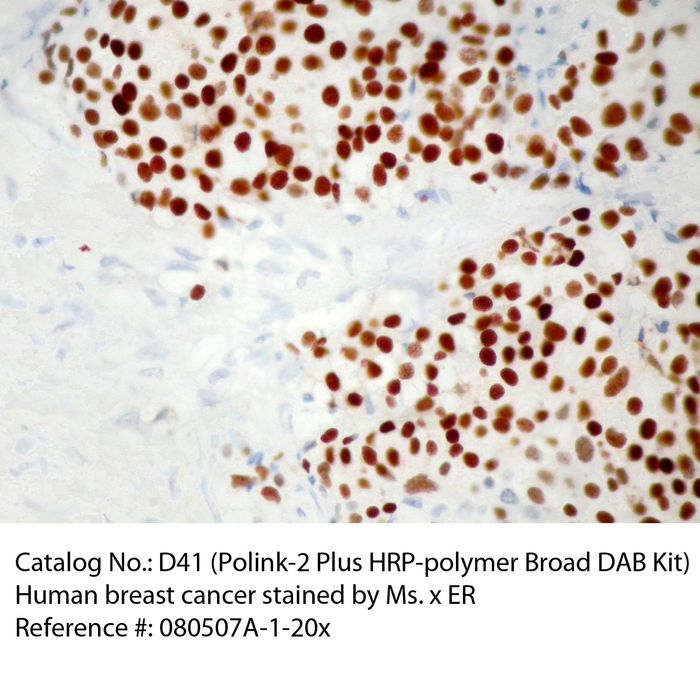 IHC staining of FFPE human breast cancer tissue using mouse anti-ER polyclonal antibody and Polink-2 Plus HRP Broad for DAB detection kit D41-18. The brown stain indicates positive stain and blue is the counter stain. It is mounted using a permanent organic mounting medium E37-100.
