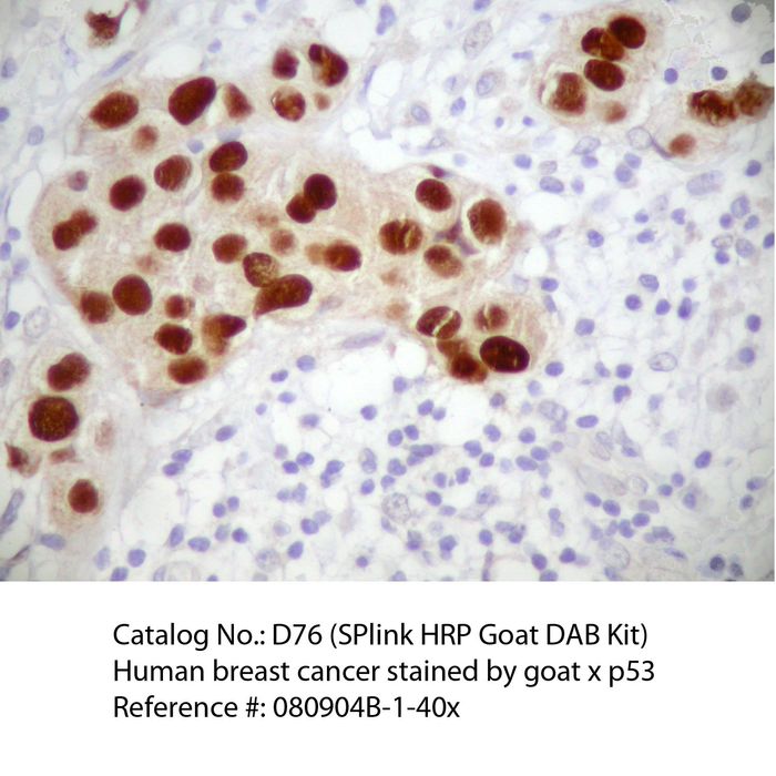 IHC staining of FFPE human breast cancer tissue using goat anti-p53 polyclonal antibody and SPlink HRP Goat for DAB detection kit D76-18. The brown stain indicates positive stain and blue is the counter stain. It is mounted using a permanent organic mounting medium E37-100.