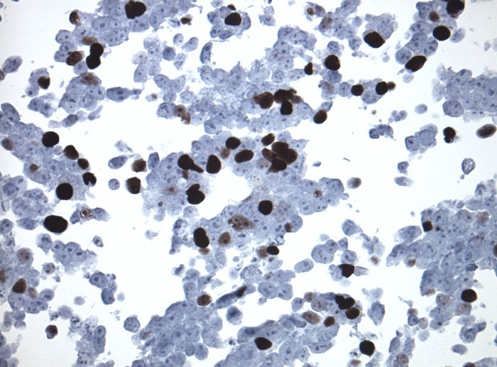 Immunohistology staining on RB1 overexpressed cytosection TS406933P5 with mouse anti DDK clone OTI11C3 C/N <a href = "https://www.origene.com/catalog/antibodies/tag-antibodies/ta180144-ddk-flag-mouse-monoclonal-antibody-clone-oti11c3" title="TA180144" class="">TA180144</a> at 1:400 dilution 4C O/N. Antibody staining was achieved with HIER Citrate pH6 , Polink1 with DAB chromogen detection kit (D11-18). Positive stain shown with the brown chromogen present. HEK293T cells were transfected with cDNA clone <a href = "https://www.origene.com/catalog/cdna-clones/expression-plasmids/rc206933-rb-rb1-nm-000321-human-tagged-orf-clone" title="RC206933" class="">RC206933</a>, 5 micron sections, 40x magnification