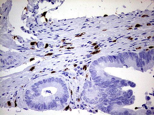 Immunohistochemical staining of paraffin-embedded Adenocarcinoma of Human colon tissue using anti-S100A9 mouse monoclonal antibody. (UM800066; heat-induced epitope retrieval by 1mM EDTA in 10mM Tris, pH8.0, 120°C for 3min)