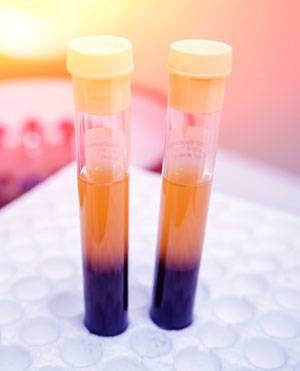 COVID-19 Serum or Plasma Sample