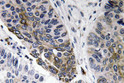 Immunohistochemistry analysis of IgA antibody in paraffin-embedded human lung carcinoma tissue.