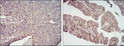 Immunohistochemistry analysis of paraffin-embedded cervical cancer tissues (left) and ovarian cancer tissues (right) with DAB staining using CD276 monoclonal antibody.