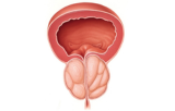 Cancer de la prostate