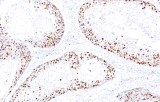 Anti-Ki-67 CE/IVD pour IHC - pathologies gynécologiques